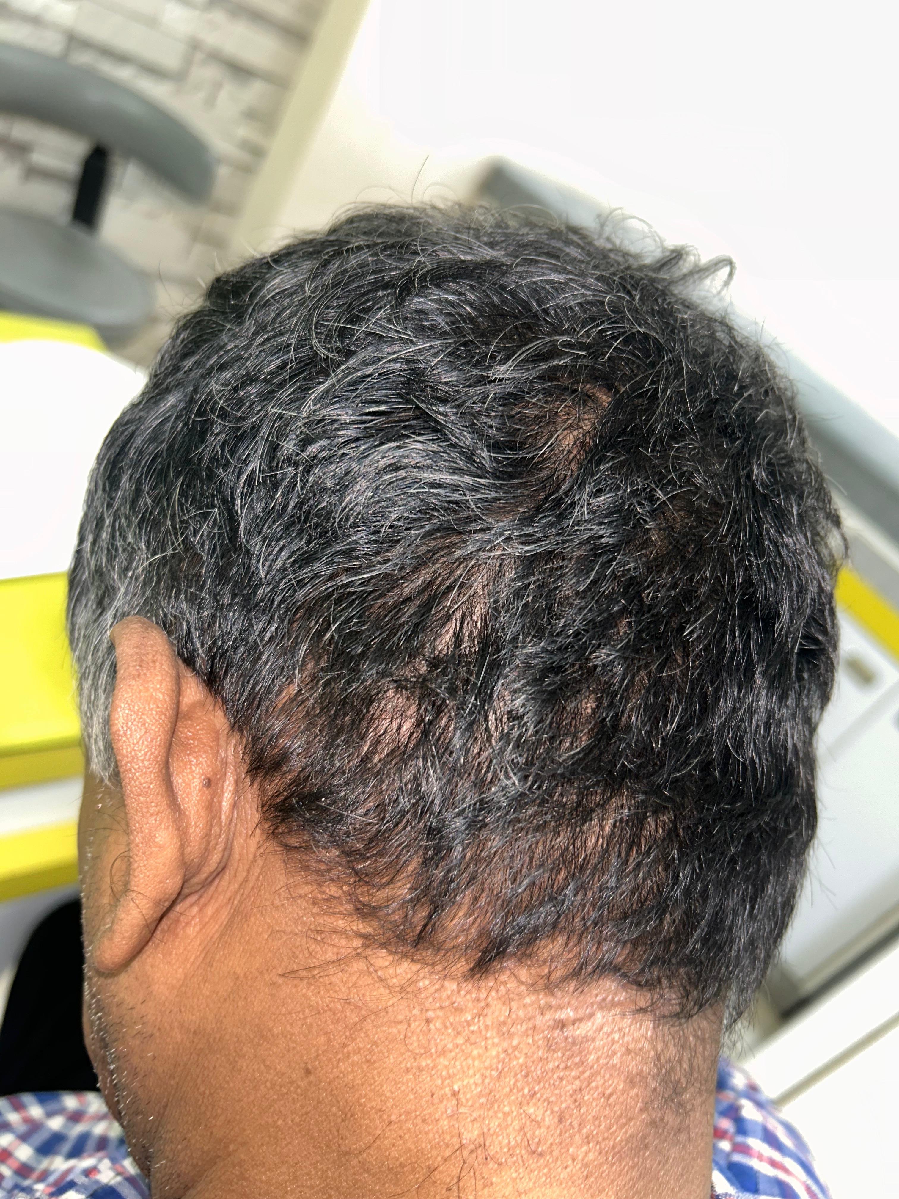 After Pyogenic Granuloma Cautery