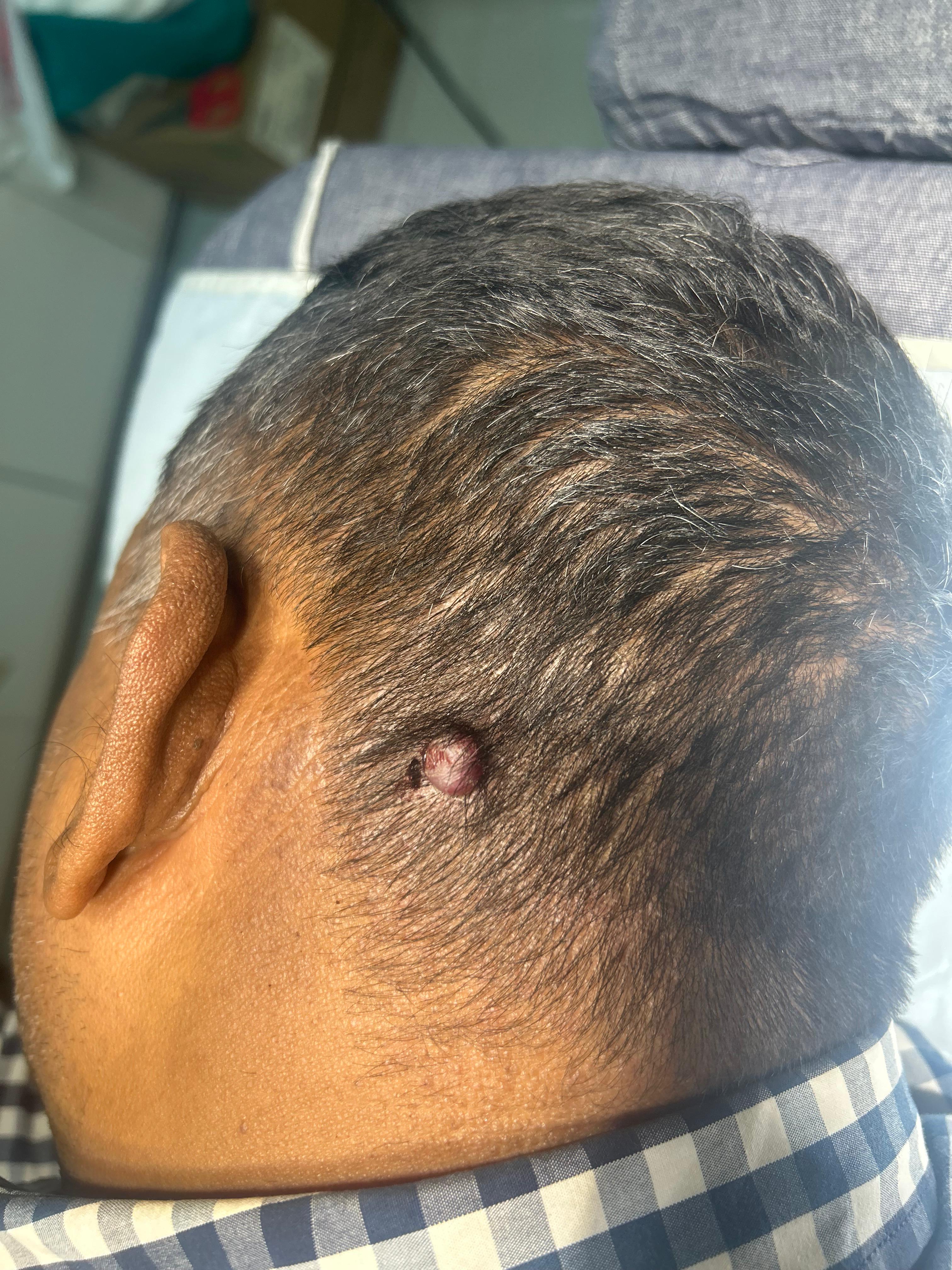 Before Pyogenic Granuloma Cautery
