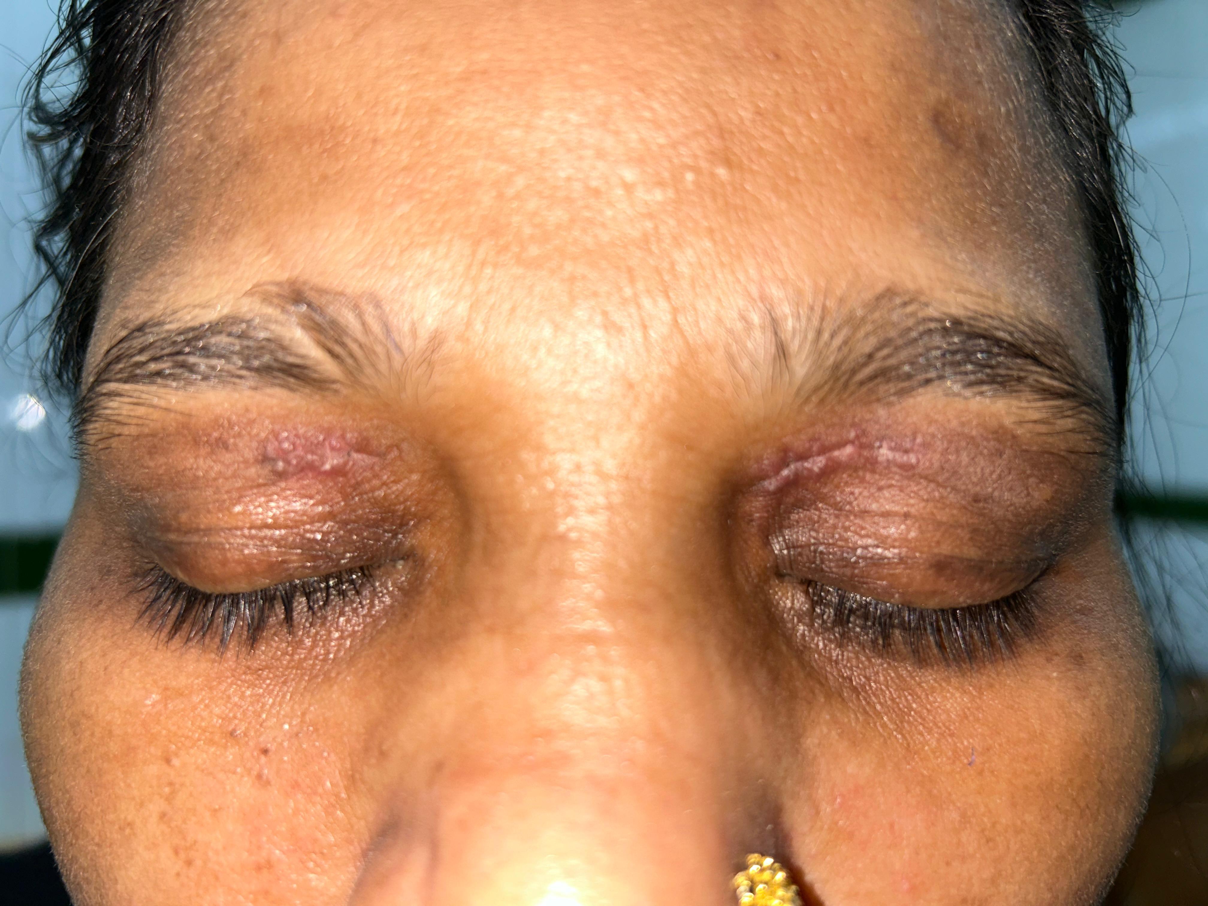 After Xanthelasma Removal