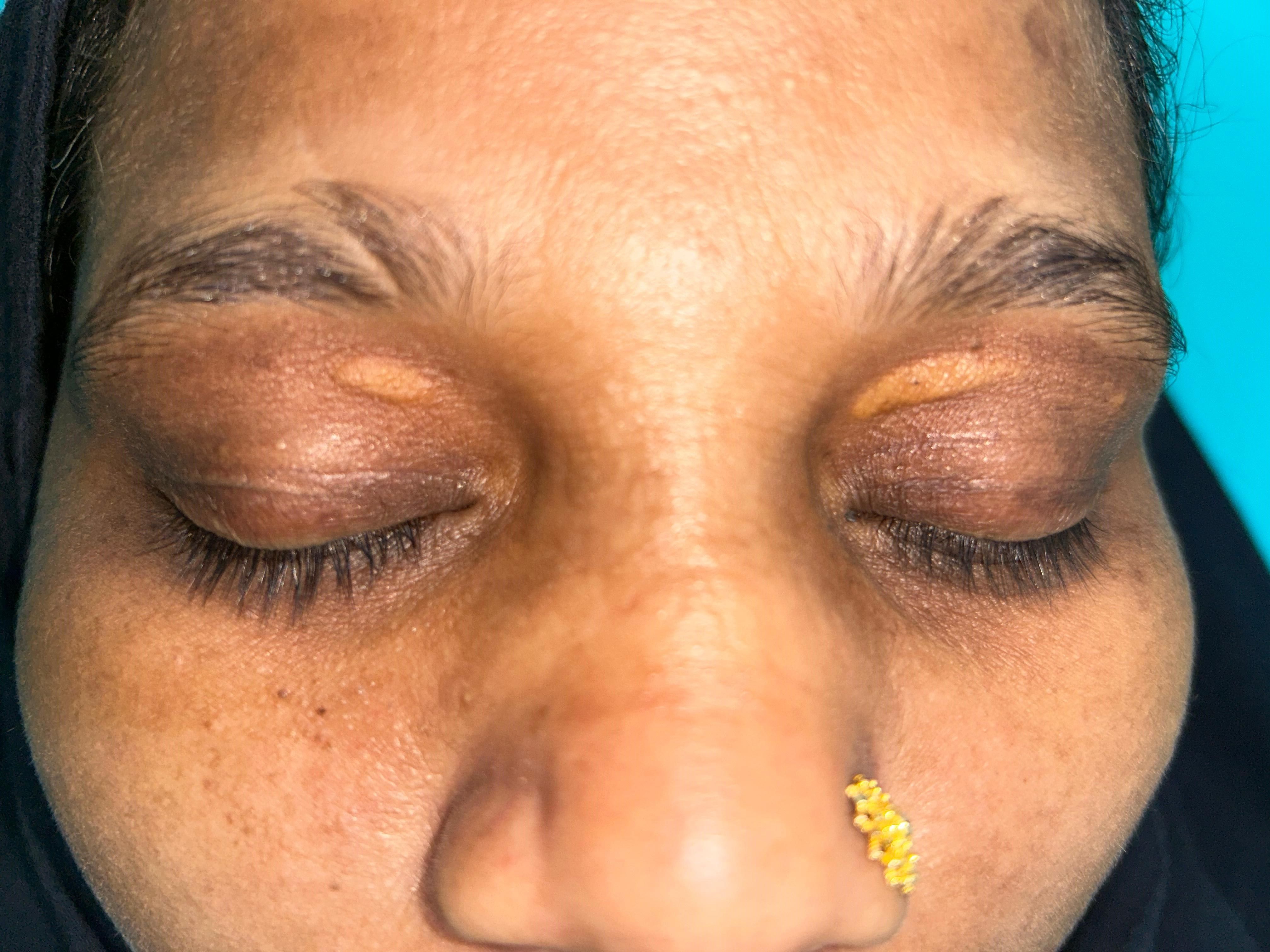 Before Xanthelasma Removal