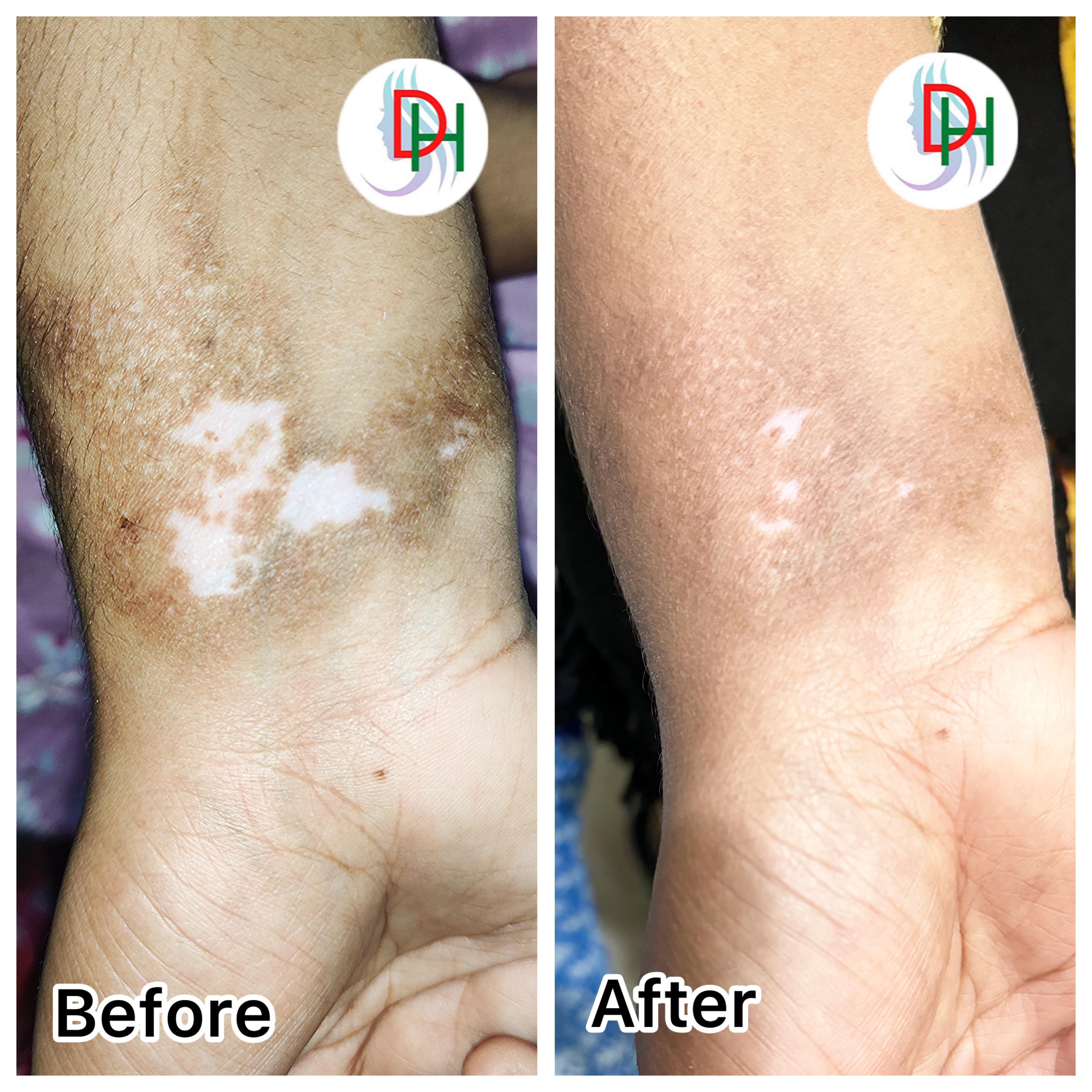 Vitiligo Treatment Image 2