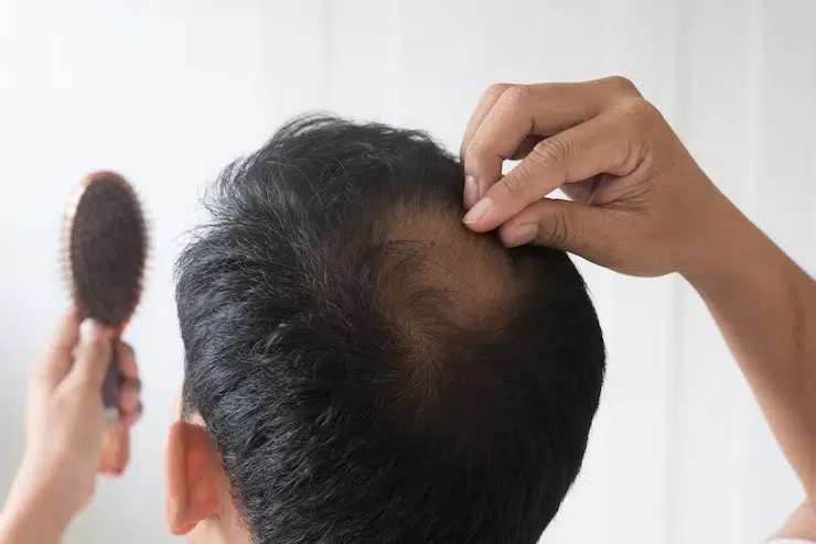 Hair transplant before and after results