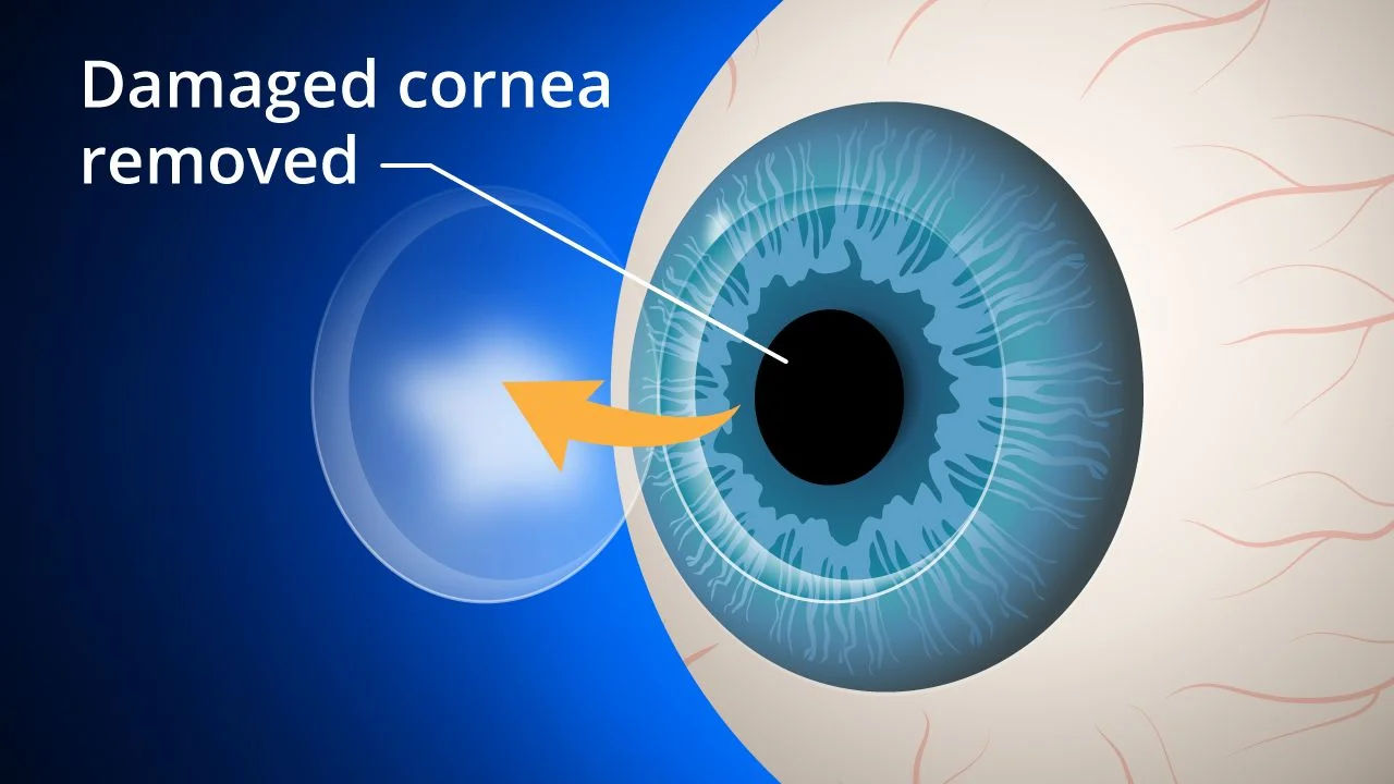Corneal Transplant Surgery in Mumbai – Restoring Vision with Keratoplasty