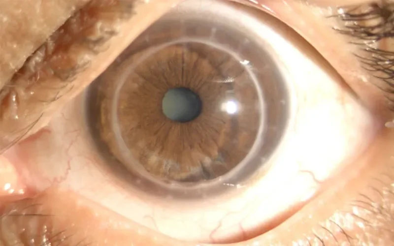 Corneal Transplant Surgery in Mumbai – Restoring Vision with Keratoplasty