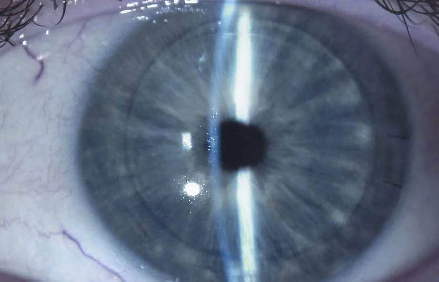 Corneal Transplant Surgery in Mumbai – Restoring Vision with Keratoplasty