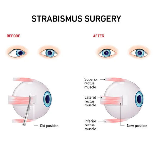 Squint Correction Surgery