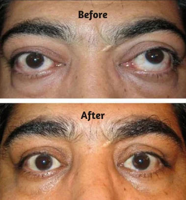 Squint Correction Surgery in Mumbai – Functional & Cosmetic Results