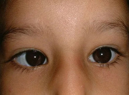 Squint Correction Surgery in Mumbai – Functional & Cosmetic Results