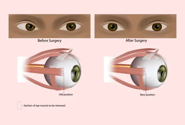 Squint Correction Surgery in Mumbai – Functional & Cosmetic Results