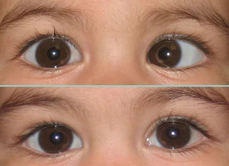 Squint Correction Surgery in Mumbai – Functional & Cosmetic Results
