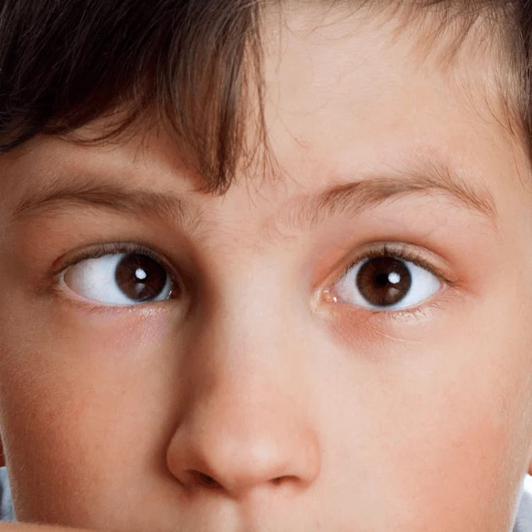 Squint Correction Surgery in Mumbai – Functional & Cosmetic Results