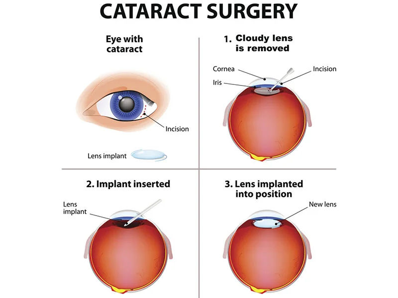 Cataract Surgery