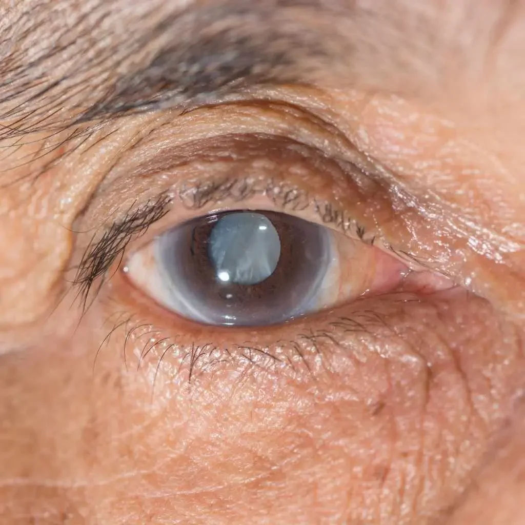 Cataract Surgery in Mumbai with Premium Lens Options