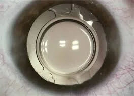 Extended Depth of Focus (EDOF) IOL Surgery in Mumbai – Natural Vision After Cataract
