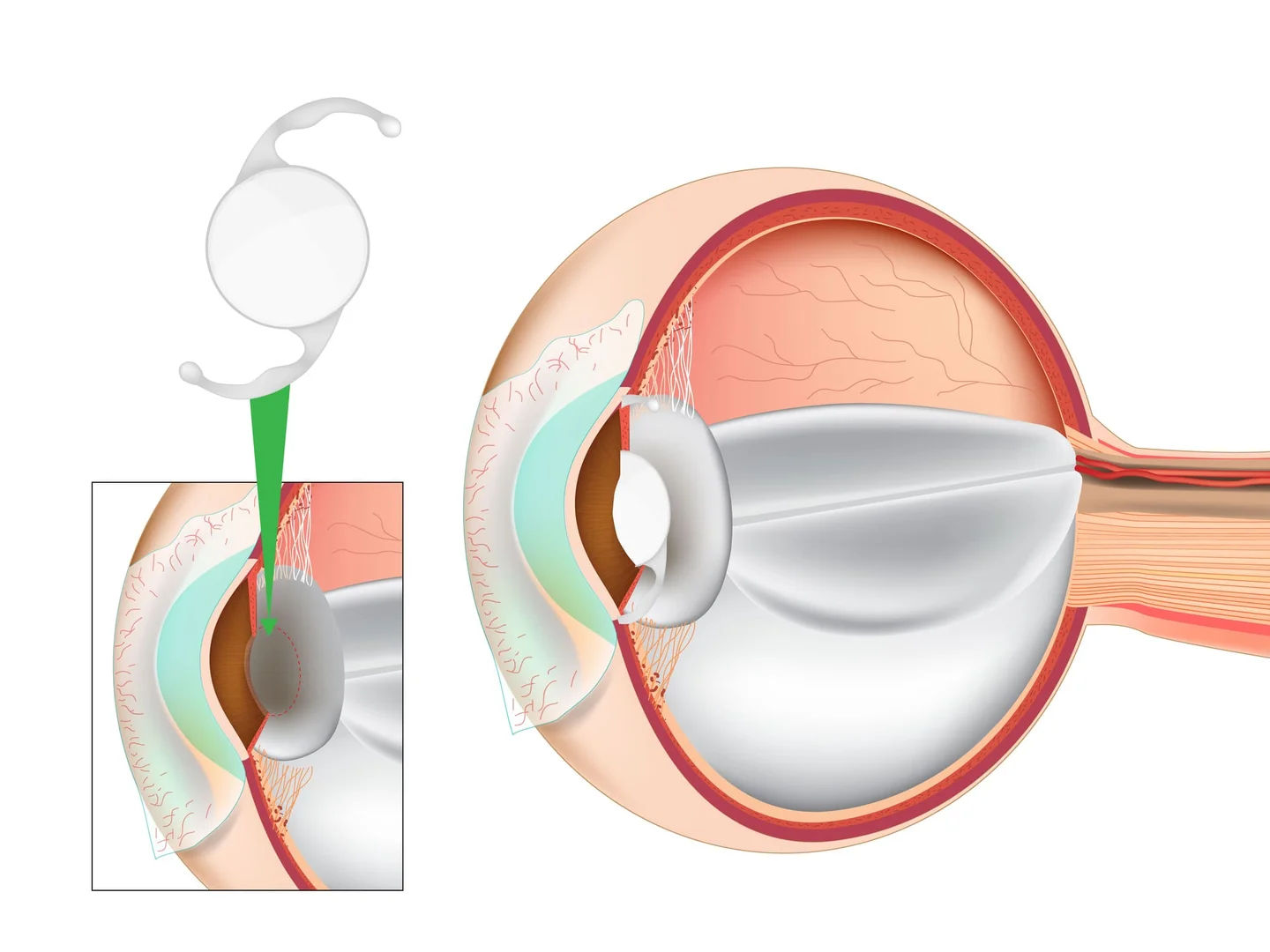 Extended Depth of Focus (EDOF) IOL Surgery in Mumbai – Natural Vision After Cataract