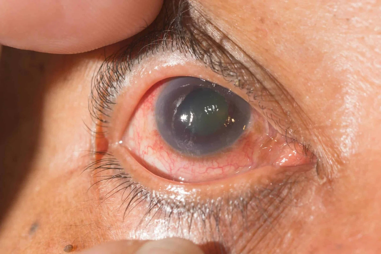 Glaucoma Treatment in Mumbai (Medical, Laser & Surgical)