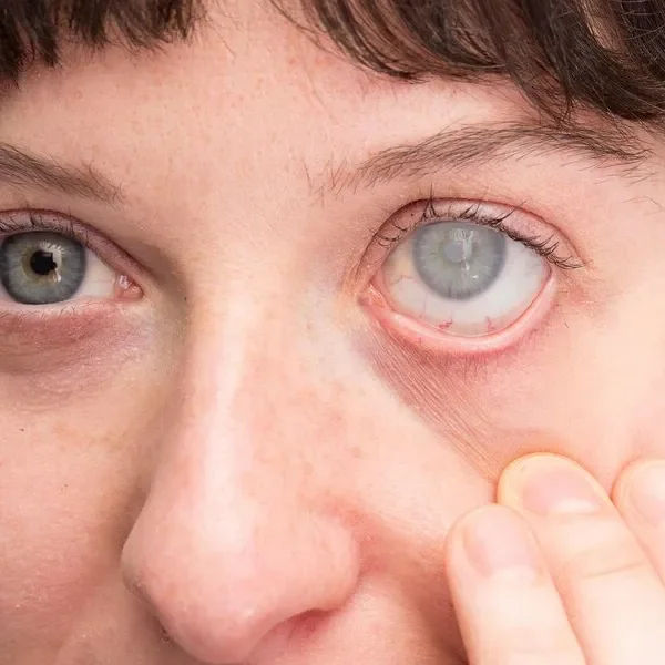 Glaucoma Treatment in Mumbai (Medical, Laser & Surgical)