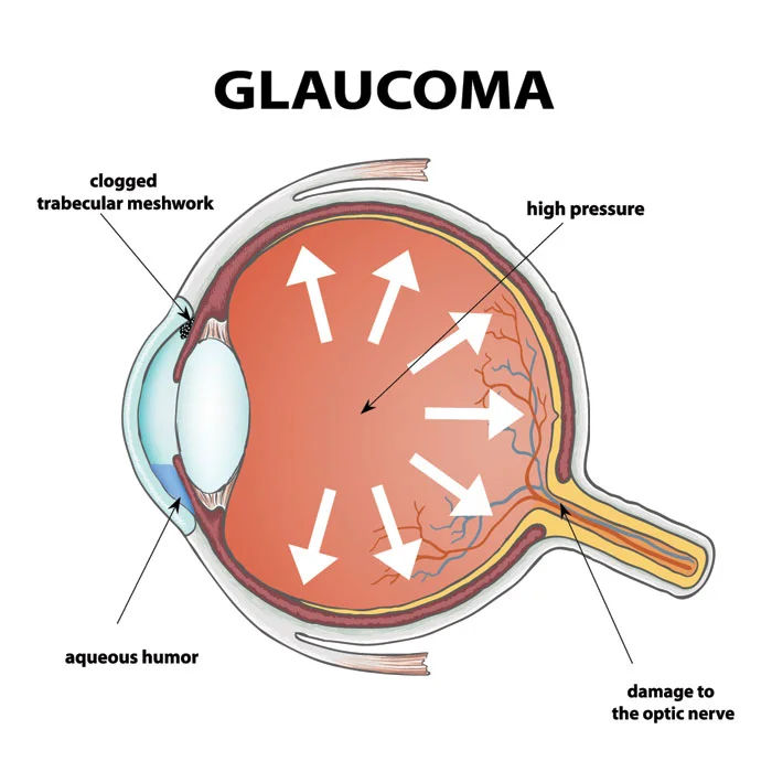 Glaucoma Treatment in Mumbai (Medical, Laser & Surgical)