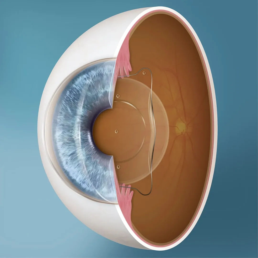 ICL Surgery in Mumbai (Phakic IOL for High Myopia)