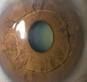 ICL Surgery in Mumbai (Phakic IOL for High Myopia)