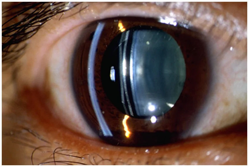 ICL Surgery in Mumbai (Phakic IOL for High Myopia)