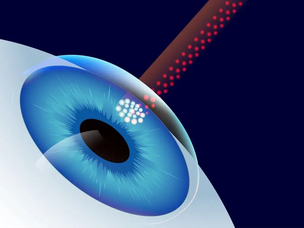 LASIK Surgery