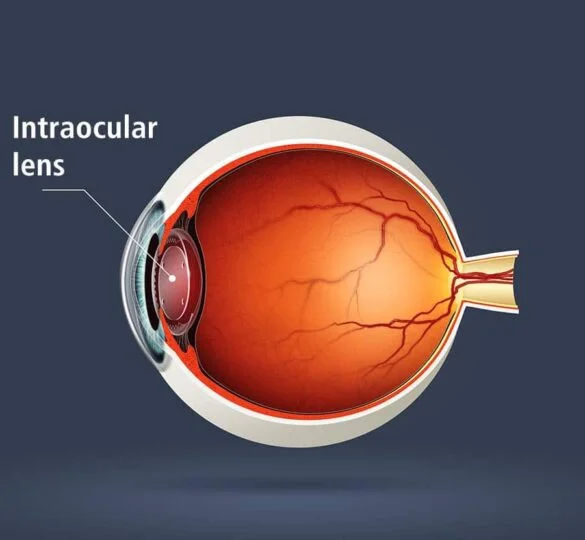 Multifocal IOL Surgery in Mumbai – Clear Vision at All Distances