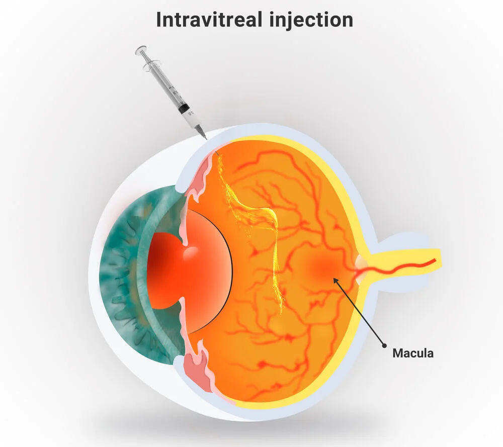Retinal Injections
