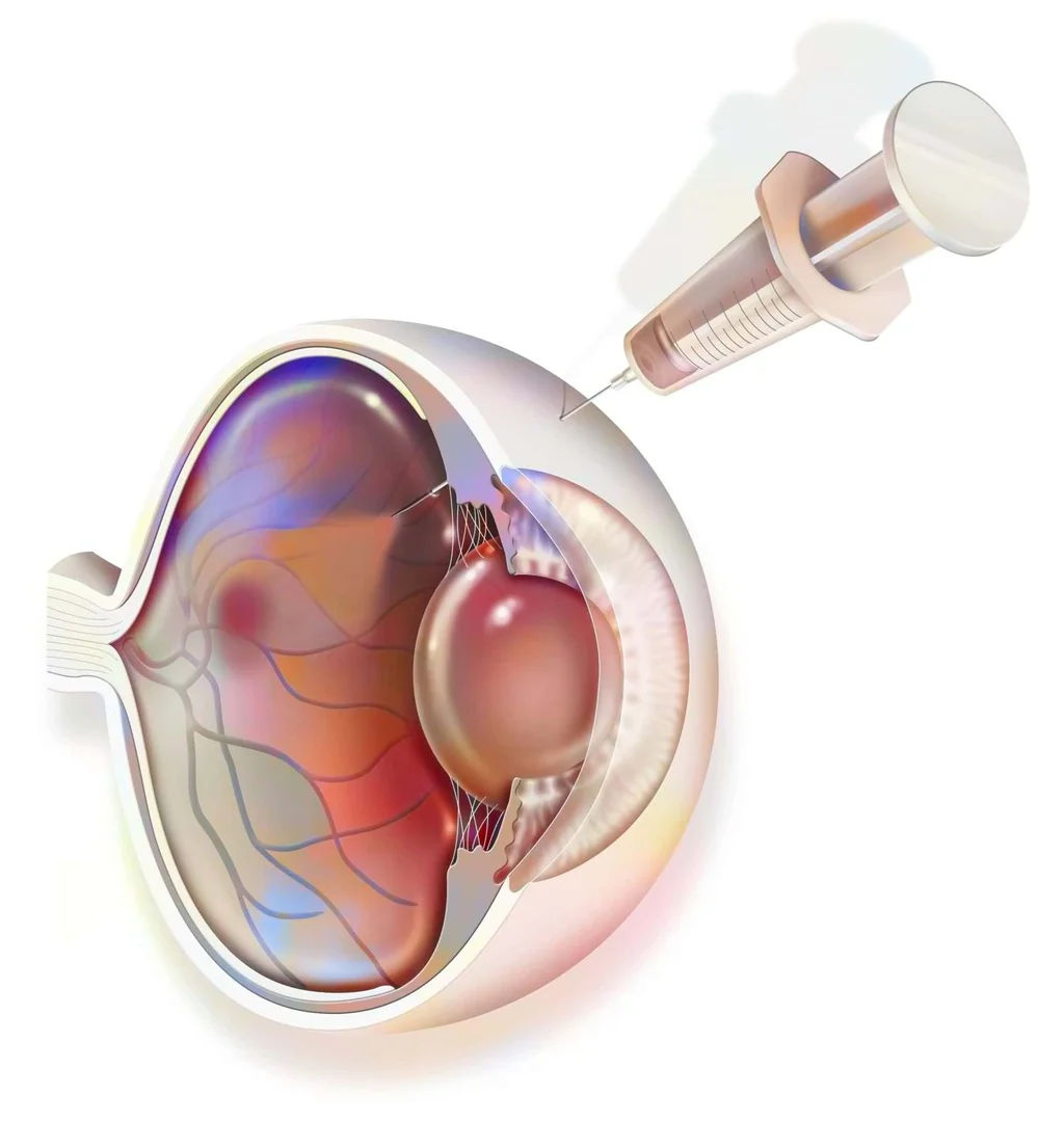 Retinal Injections in Mumbai (Anti-VEGF for ARMD & Retinal Diseases)