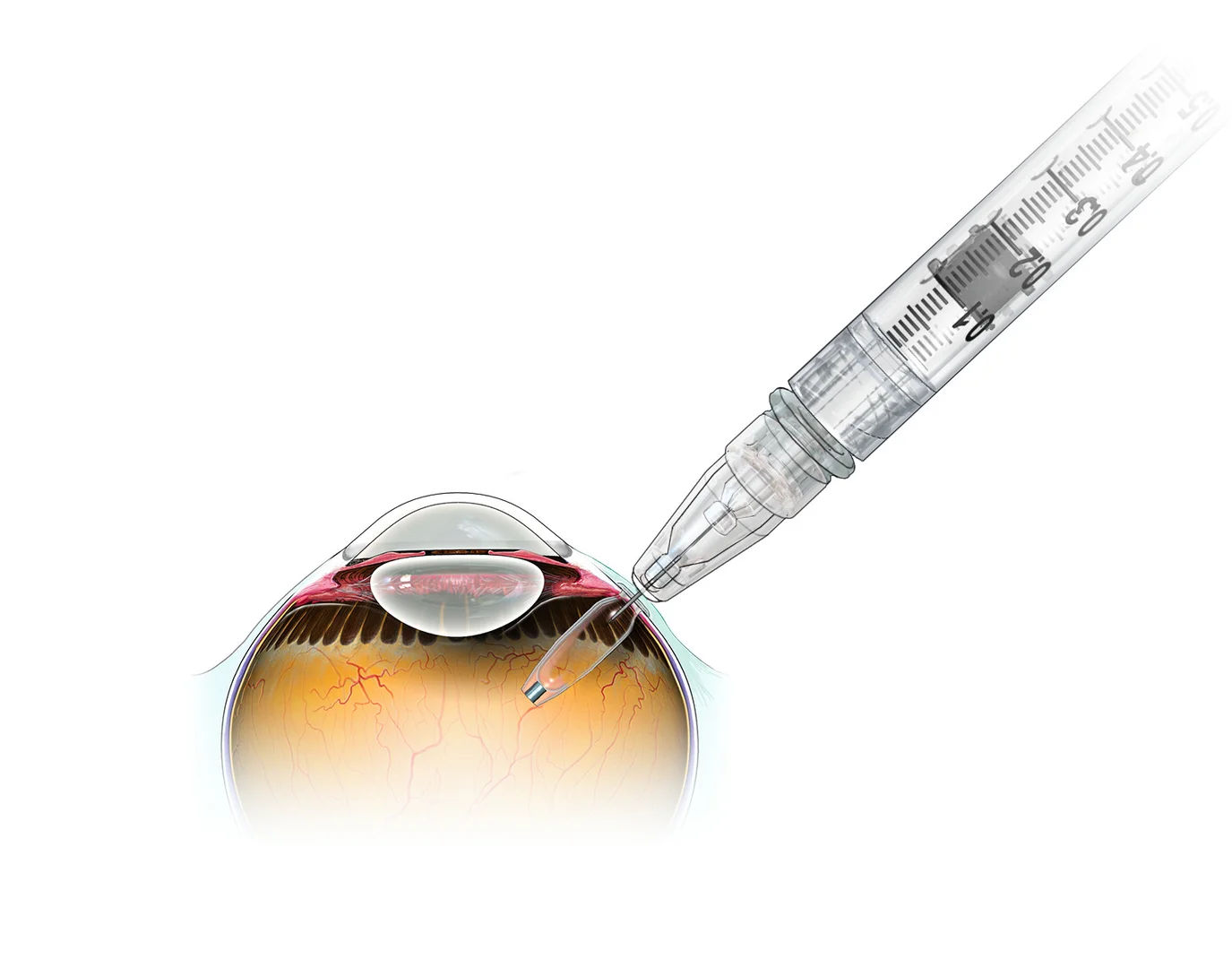 Retinal Injections in Mumbai (Anti-VEGF for ARMD & Retinal Diseases)