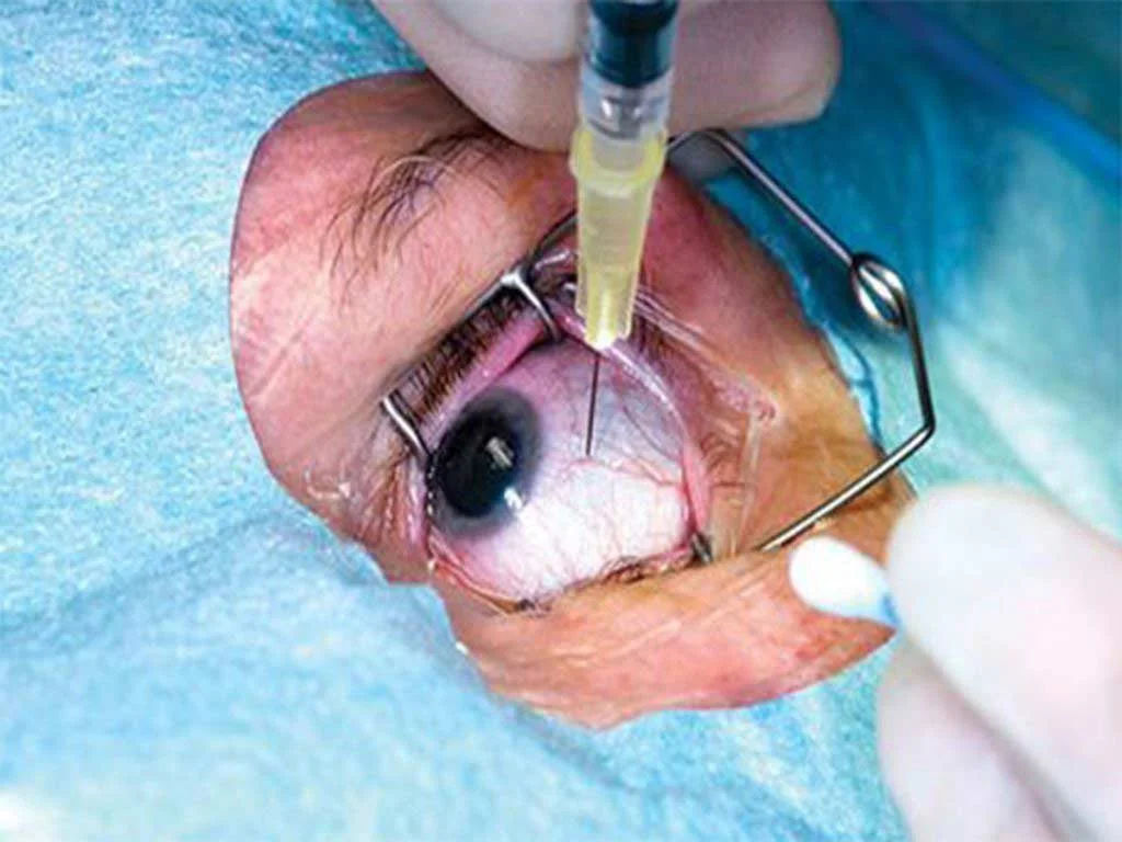 Retinal Injections in Mumbai (Anti-VEGF for ARMD & Retinal Diseases)