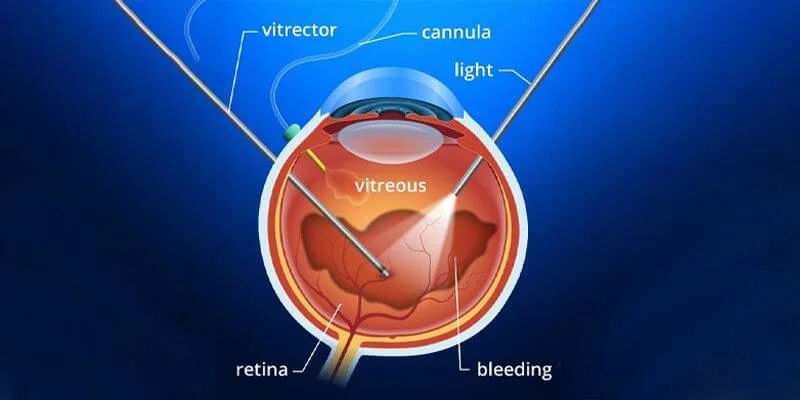Retinal Surgery