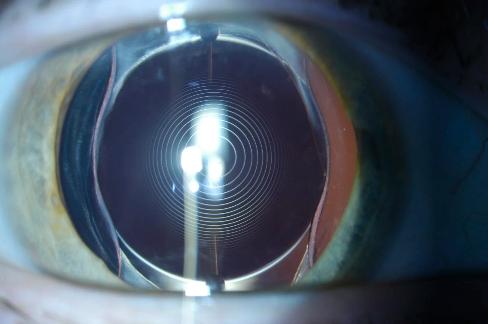 Trifocal IOL Surgery