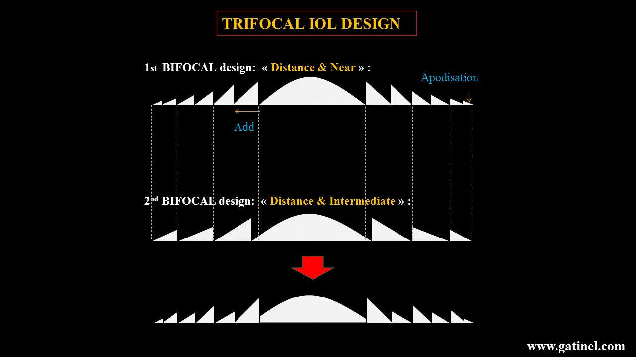 Trifocal IOL Surgery in Mumbai – Complete Vision Correction