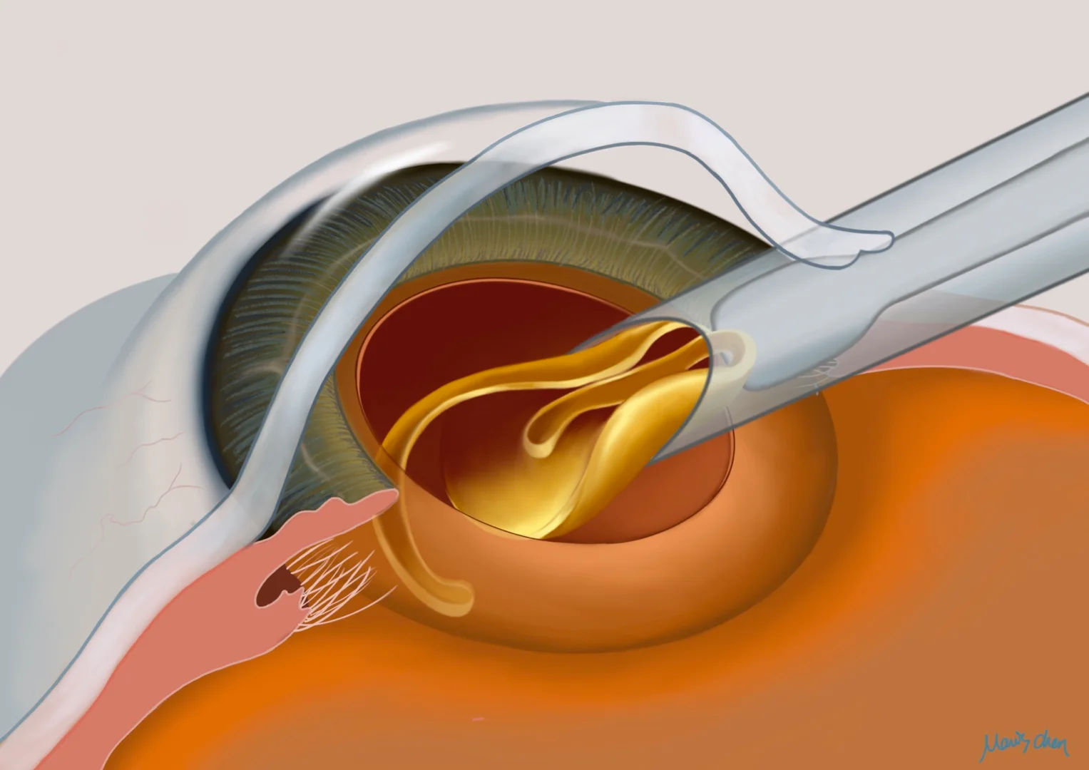 Trifocal IOL Surgery in Mumbai – Complete Vision Correction