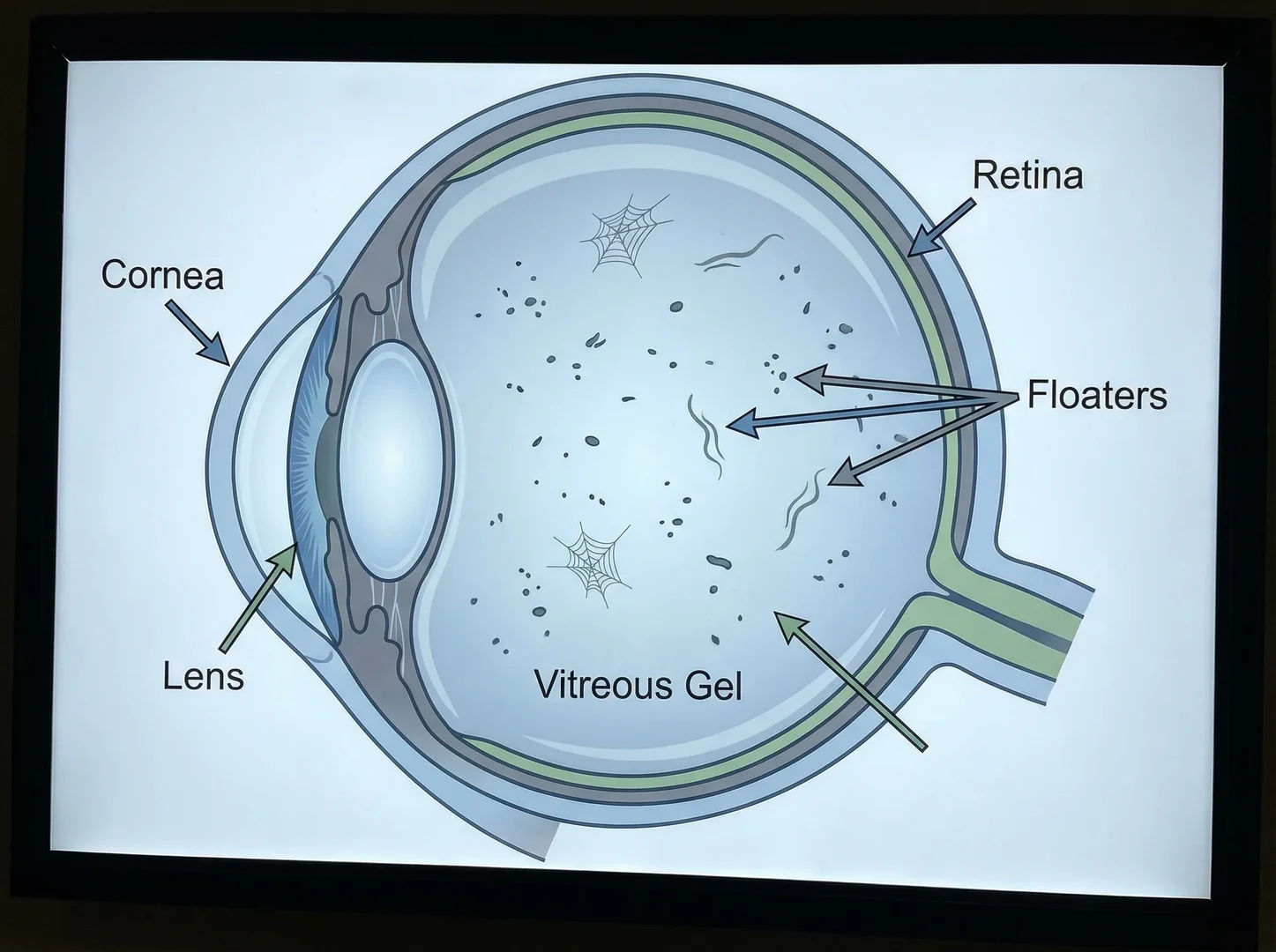 Are Eye Floaters Normal After the Age of 40?