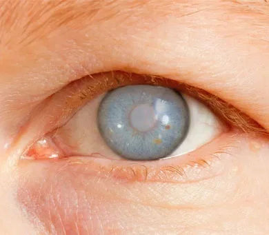 Best Glaucoma Treatment in Mumbai