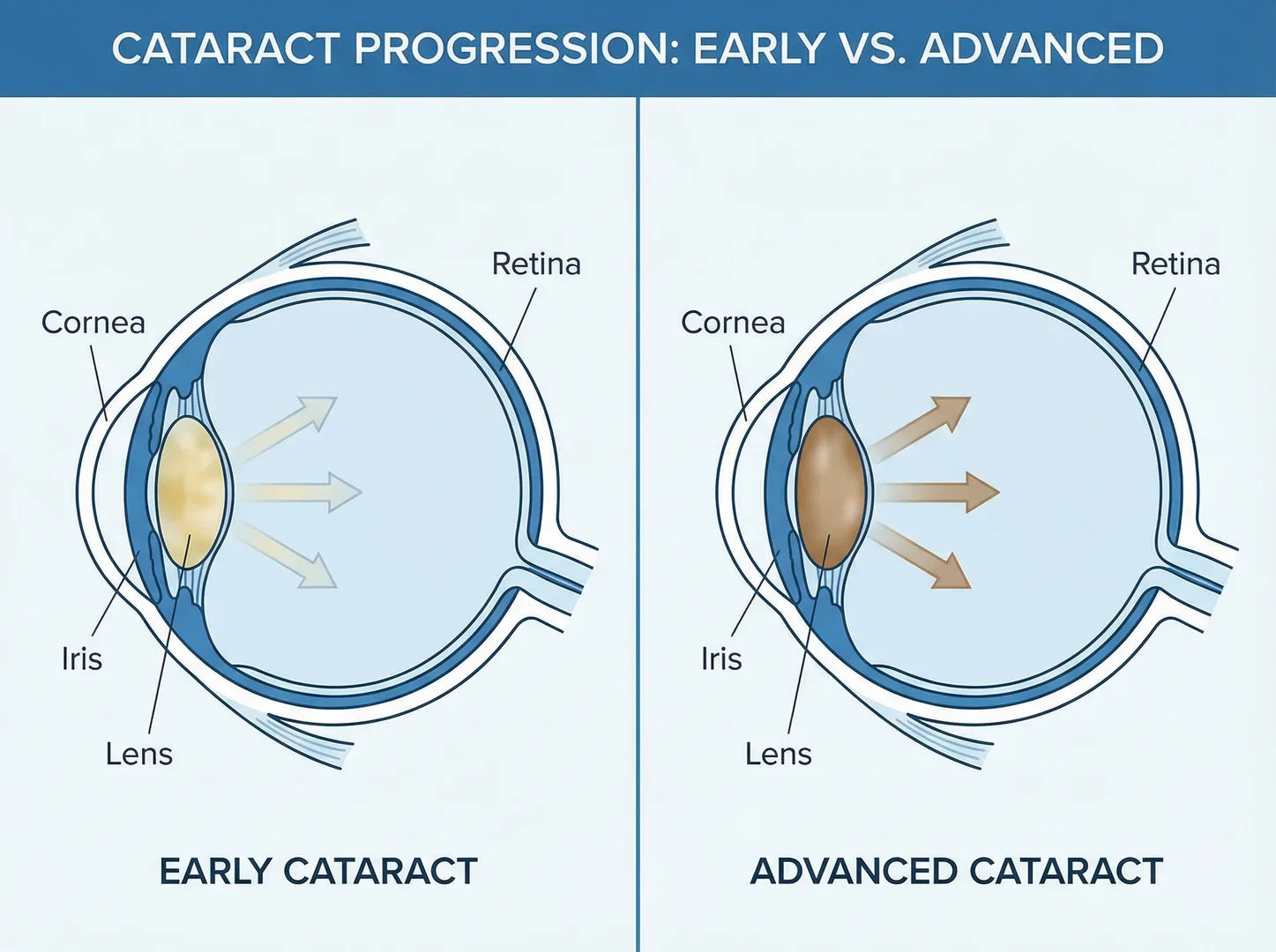 At What Age Should Cataract Surgery Be Done?
