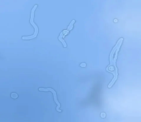 When Floaters Mean Trouble: Understanding Retina Health