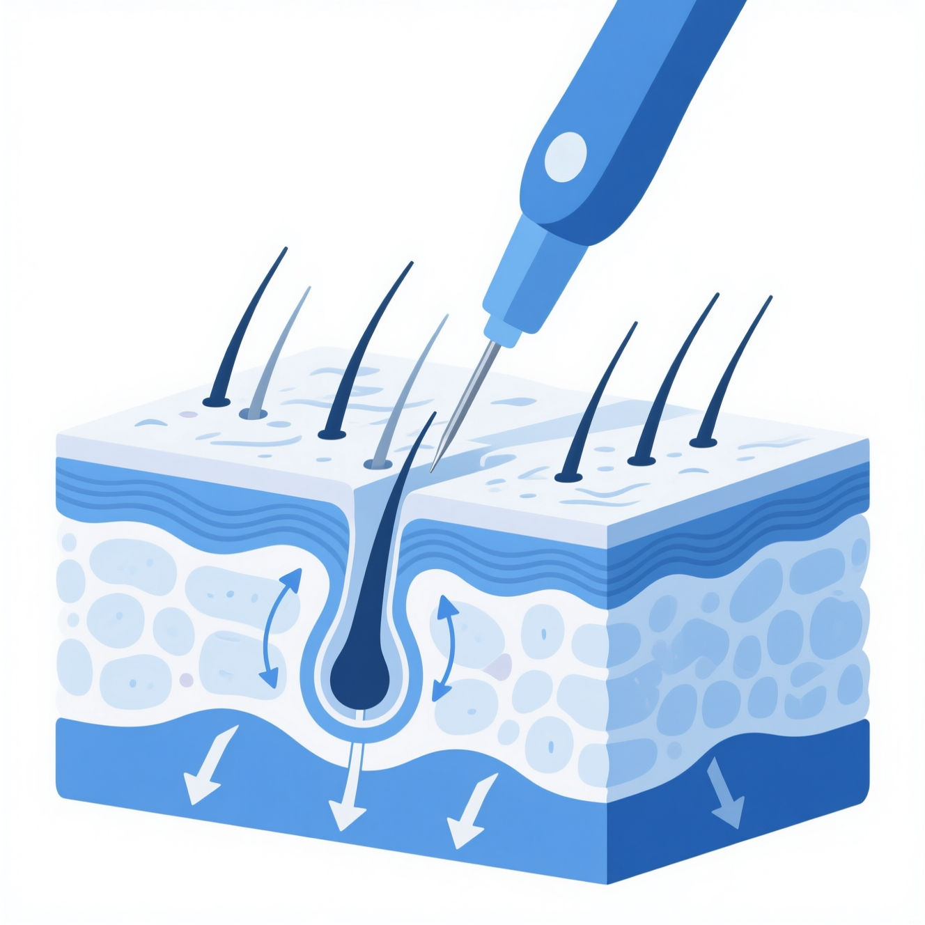 Acne Scars Before/After - Boxcar Scars Results