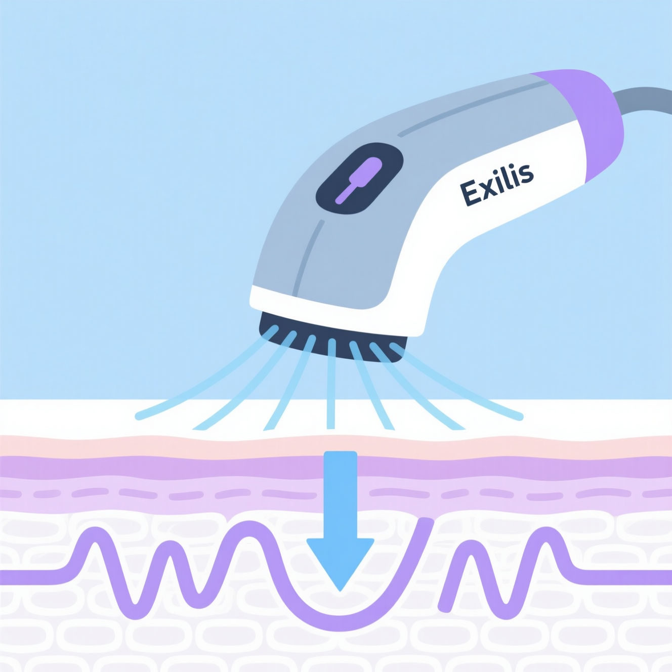 Exilis Before/After - Skin Tightening Results