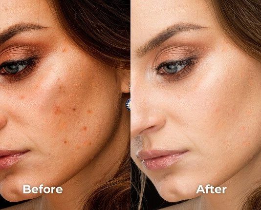 Yüzdeki kahverengi lekeler nasıl geçer?