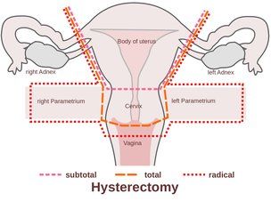 Diagram of hysterectomy types