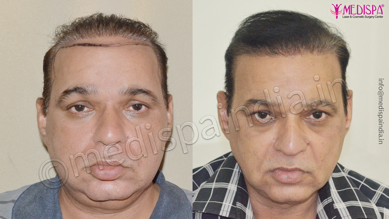 bad hair transplant repair india 
