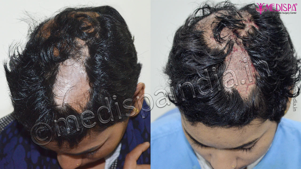 burn hair transplant india