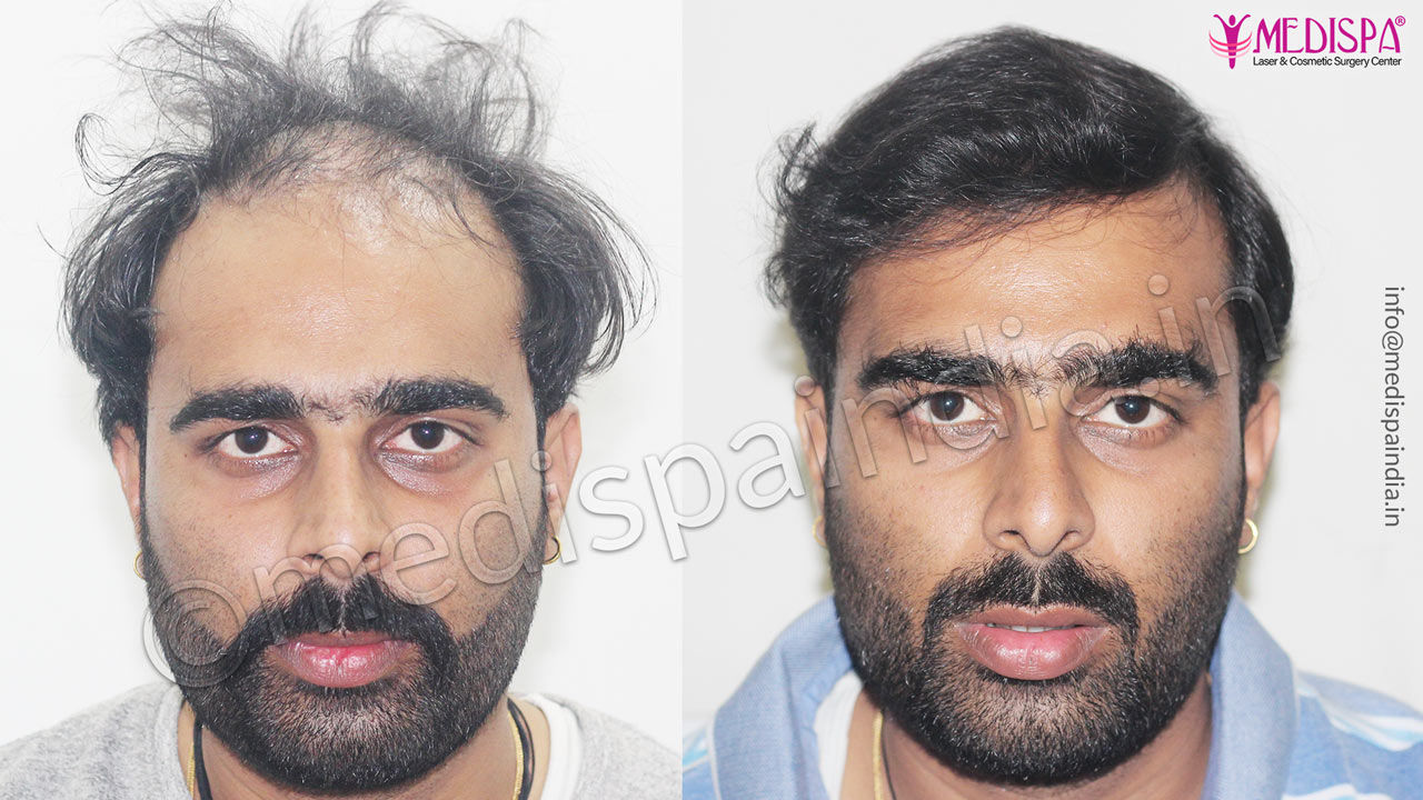 hair transplant before and after