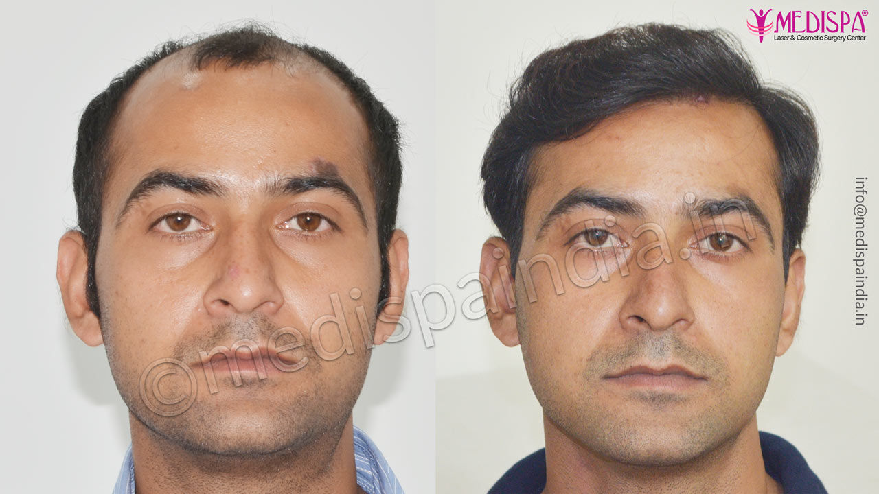 dubai hair transplant result