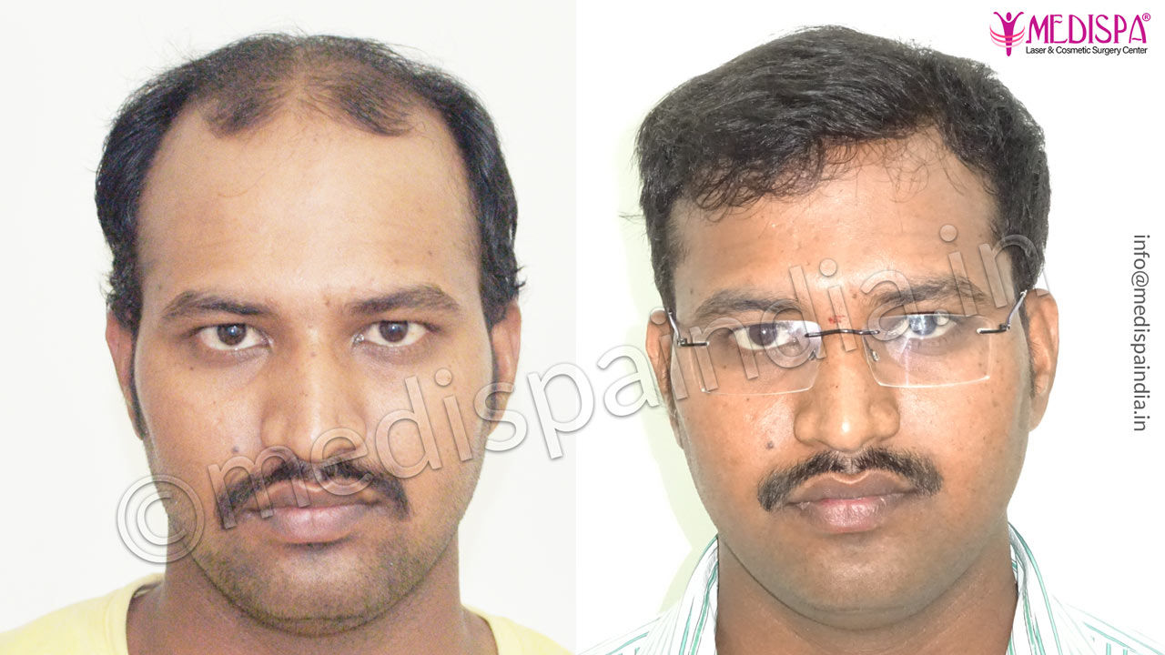 Bangalore hair transplant result