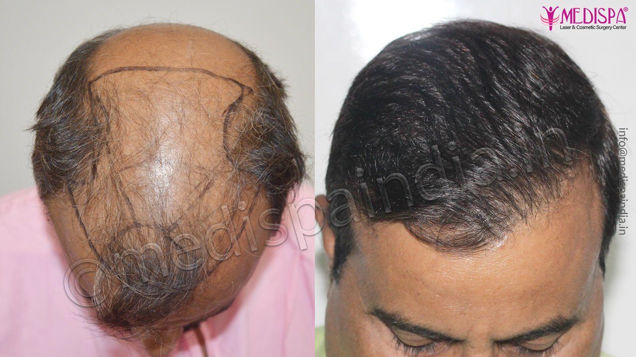 hair transplant cost in dubai