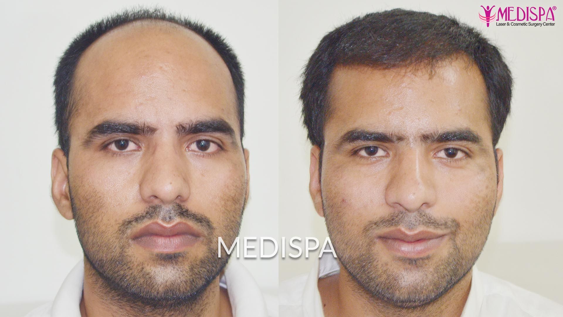 dubai hair transplant result